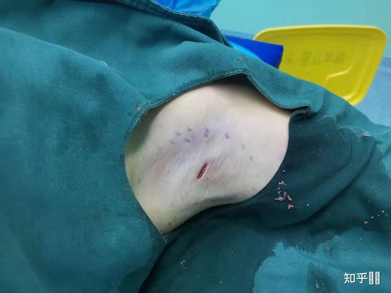 腋臭手术多少钱