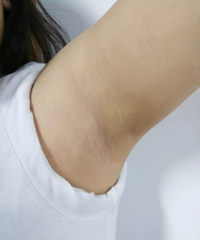 腋臭手术多少钱可以根治吗成都做狐臭手术经历分享
