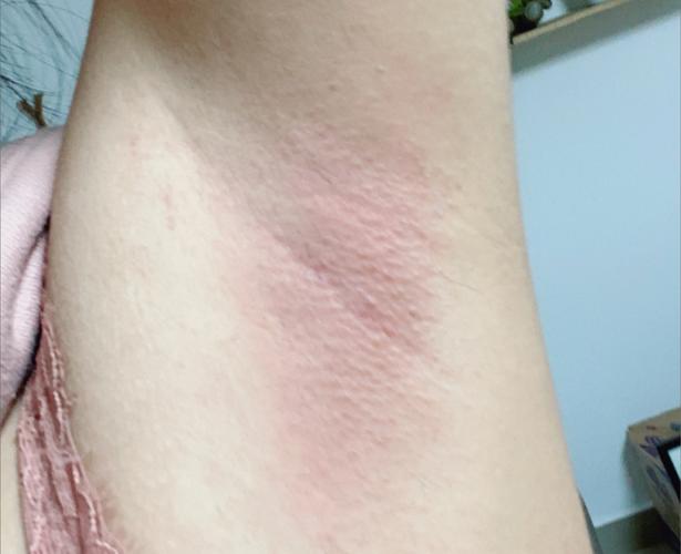 腋下异味怎么办